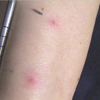 
	Beh&ccedil;et syndrome - positive pathergy test