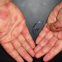 
	Orf and erythema multiforme