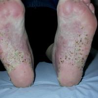 
	Palmoplantar pustulosis