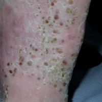
	Palmoplantar pustulosis