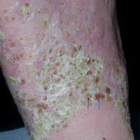 
	Palmoplantar pustulosis

	Yellow pustules…