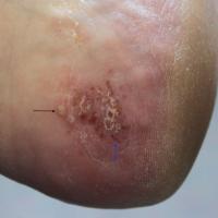 
	Palmoplantar pustulosis

	Yellow pustules…