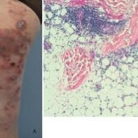 
	Cold panniculitis and histology showing lobular…