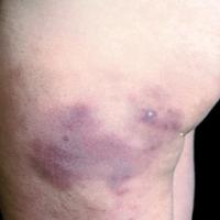 
	Cold panniculitis 