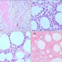 
	Lobular panniculitis