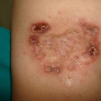 
	Lupus profundus