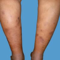 
	Nodular panniculitis&nbsp;