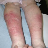 
	Panniculitis&nbsp;