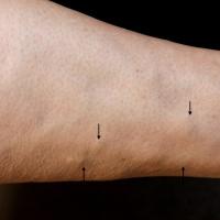 
	Nodular panniculitis

	These tender lesions…