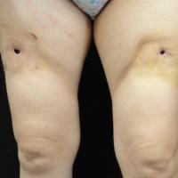 
	Panniculitis at sites of interferon injection