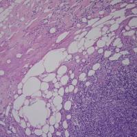 
	Septal panniculitis