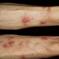 
	Panniculitis and pancreatitis 