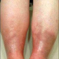 
	Sclerosing panniculitis&nbsp;