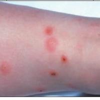 
	Papular urticaria caused by mosquitoes