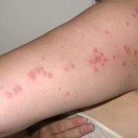 
	Papular urticaria caused by bed bugs