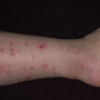 
	Papular urticaria caused by the human flea