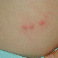 
	Papular urticaria&nbsp;

	A very typical case…