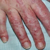 
	Multicentric reticulohistiocytosis

	Copied…