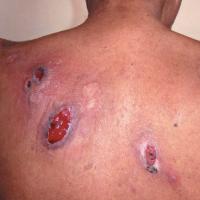 
	Pyoderma gangrenosum

	Lesions on the trunk are…
