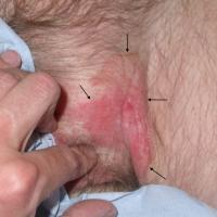 
	Extramammary Paget's disease