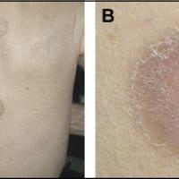 
	Pityriasis rotunda