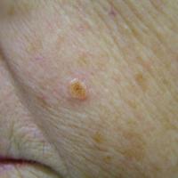 
	Sebaceous adenoma

	Can suggest…