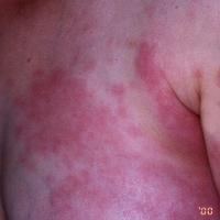 
	Sweet's syndrome - associated with…