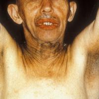 
	Malignant acanthosis nigricans associated with…