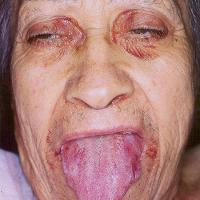 
	Systemic amyloidosis&nbsp;

	Copied with kind…