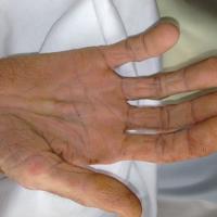 
	Tripe palms

	Secondary to carcinoma of the…