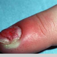 
	Acute paronychia