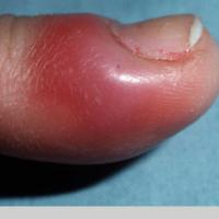 
	Acute paronychia