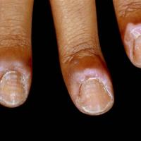 
	Chronic paronychia and transverse ridges