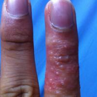 
	Herpetic whitlow