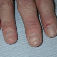 
	Chronic paronychia 