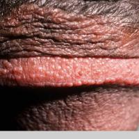 
	Pearly penile papules