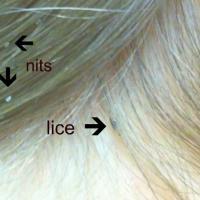 
	Head louse and nits