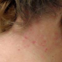 
	Itchy, papular lesions on the nape of the neck