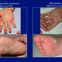 
	Acral Peeling Skin syndrome

	The two images on…