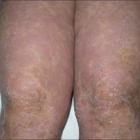 
	Erythrokeratoderma variabilis -…