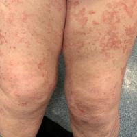 Oudtshoorn disease - more extensive
This was…