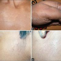 
	Peeling Skin syndrome - type A…