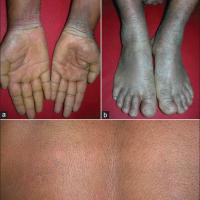 
	Peeling skin syndrome - type B…