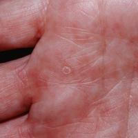 
	Keratolysis exfoliativa