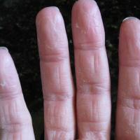 
	Keratolysis exfoliativa