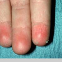 
	Keratolysis exfoliativa