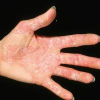 
	Oudtshoorn disease