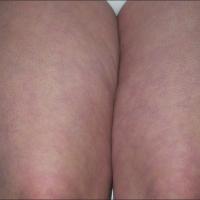 
	Same patient as previous image - treated with…
