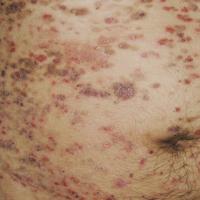 
	Pemphigus foliaceus

	Copied with kind…