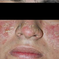 
	Pemphigus erythematosus